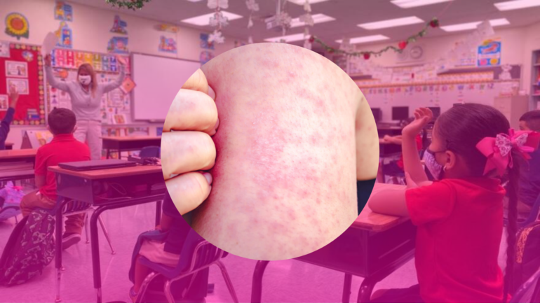 Measles Alert: Case Reported at Miami-Dade High School 🚨